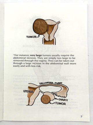 After Hysterectomy WHAT?